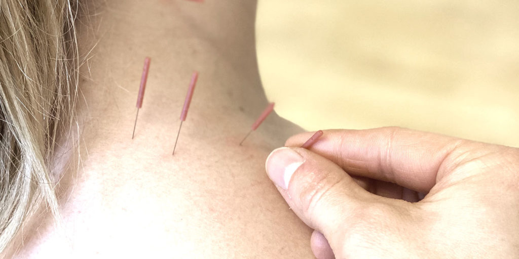 Akupunktur | FysioDanmark Randers